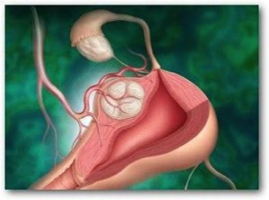 mioma uterino