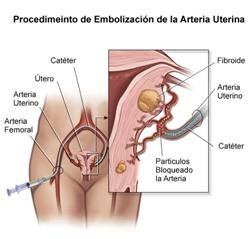 miomas uterinos