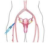 miomas uterinos