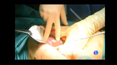 Hospital de Manises - Cirugia Hepatica
